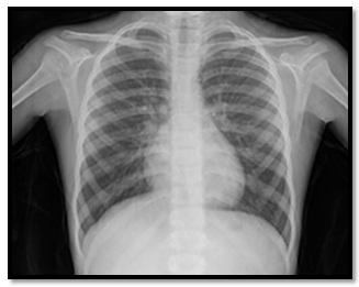 1592_X-ray of chest.jpg